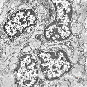  F,31y. | initial glomerular hyalinosis and sclerosis